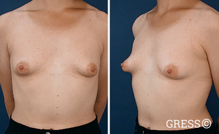 Brustimplantate zu kleine Brust