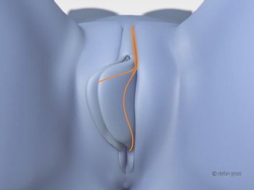 Klitoris vorhaut entfernen